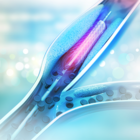 Interventional Cardiology